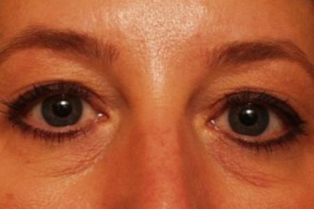 Before image 1 Case #81746 - Eyelid Surgery