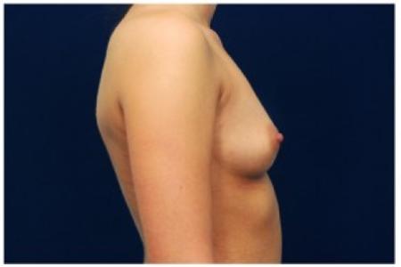 Before image 3 Case #87691 - Breast Augmentation
