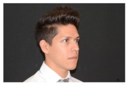 Before image 2 Case #87106 - Non-Surgical Rhinoplasty