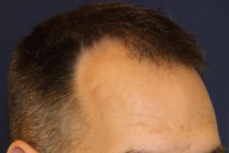 Before image 2 Case #87376 - Hair Transplantation San Diego