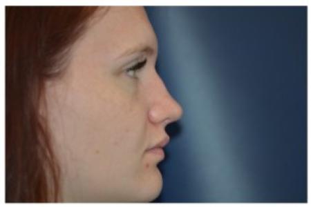 Before image 1 Case #87101 - Non-Surgical Rhinoplasty