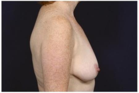 Before image 3 Case #86281 - 49 year old woman treated with a Breast Lift