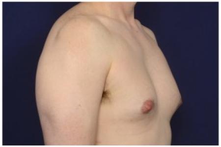 Before image 2 Case #86206 - 42 year old man treated with Male Breast Reduction