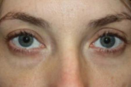Before image 1 Case #85876 - Blepharoplasty - Lower Lids Only - 34 year old female
