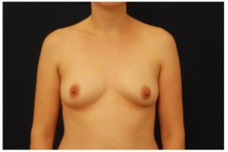 Before image 1 Case #82001 - Breast Augmentation
