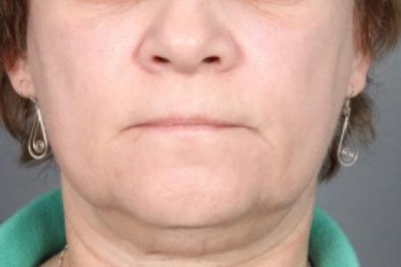 Before image 1 Case #83581 - Neck Liposuction