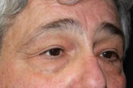 Before image 2 Case #84216 - Blepharoplasty - 61 year old male