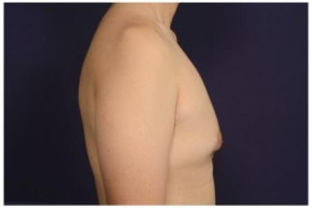 Before image 3 Case #84501 - Gynecomastia