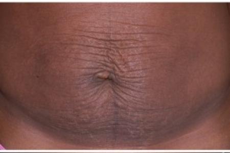 Before image 1 Case #86971 - Tummy Tuck