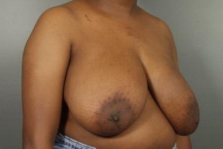 Before image 2 Case #83371 - Breast Reduction