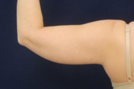 Before image 2 Case #87751 - Upper Arm Liposuction