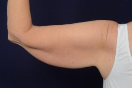 Before image 2 Case #87461 - Upper Arm Lift