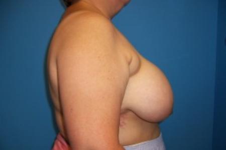 Before image 3 Case #83166 - Breast Reduction 