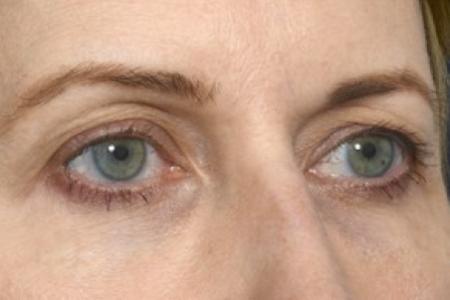Before image 3 Case #87621 - Eye Area Rejuvenation