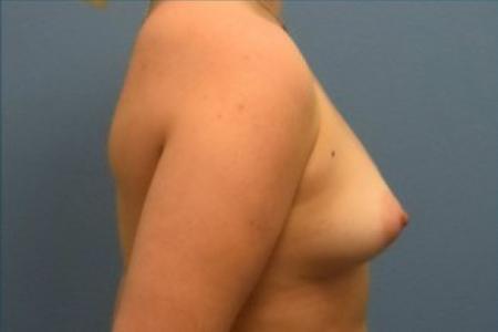 Before image 3 Case #86166 - Breast Augmentation with Silicone Implants