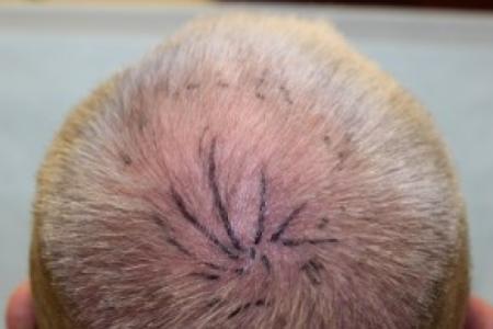 Before Case #87386 - Hair Transplantation San Diego