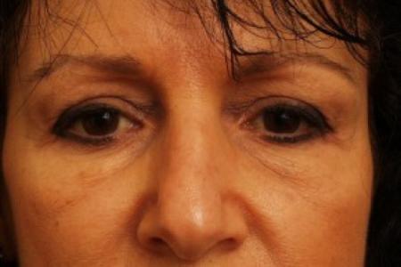 Before image 1 Case #81736 - Eyelid Surgery
