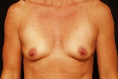Before image 1 Case #81701 - Breast Augmentation