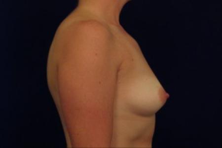 Before image 3 Case #87666 - Breast Augmentation