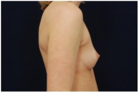 Before image 3 Case #81966 - Breast Augmentation