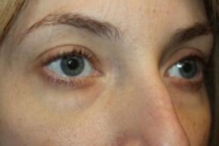 Before image 3 Case #85876 - Blepharoplasty - Lower Lids Only - 34 year old female