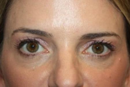 Before image 1 Case #84206 - Upper Lid Blepharoplasty - 42 year old female
