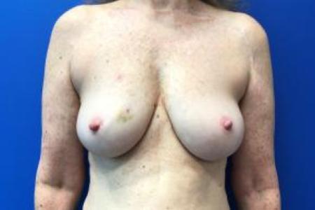 Before image 1 Case #88211 - Breast Reconstruction on a 63 year old female patient