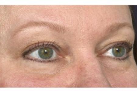 Before image 2 Case #87121 - Eye Area Rejuvenation