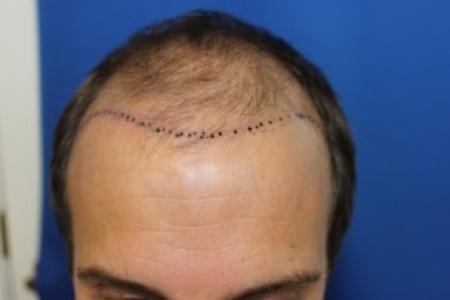 Before Case #87396 - Hair Transplantation San Diego