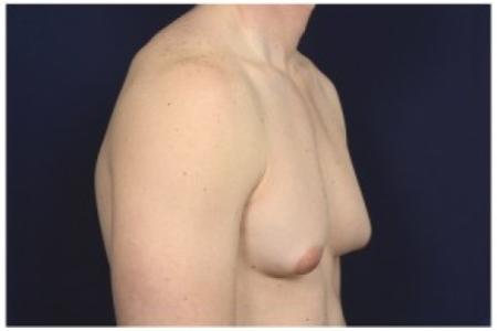 Before image 2 Case #85596 - Gynecomastia