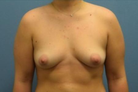 Before image 1 Case #86166 - Breast Augmentation with Silicone Implants