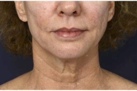 Before image 1 Case #86401 - 50 year old woman treated with lower facial rejuvenation