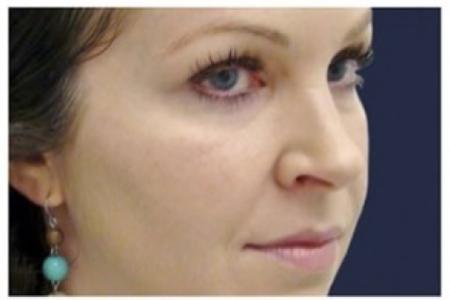 Before image 2 Case #86326 - 40 year old woman treated with Voluma