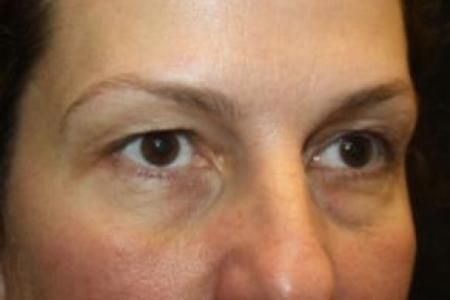 Before image 3 Case #85871 - Blepharoplasty and Browlift - 49 year old female