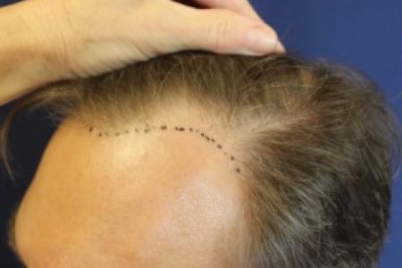 Before Case #87391 - Hair Transplantation San Diego