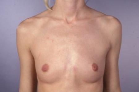 Before image 1 Case #83256 - Breast Augmentation with Saline Implants