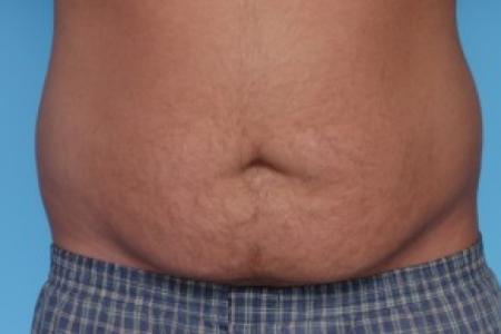 Before image 1 Case #82221 - Male Liposuction