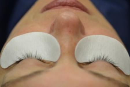 Before image 1 Case #86366 - Eyelash enhancement