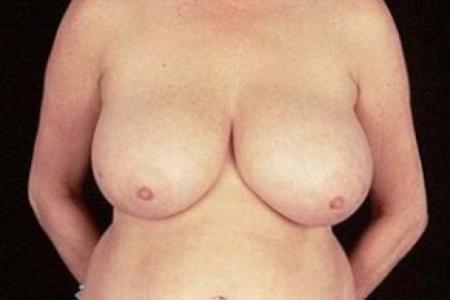 Before image 1 Case #81486 - Breast Reduction