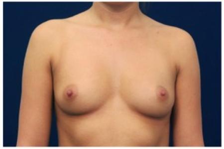 Before image 1 Case #81986 - Breast Augmentation