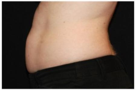 Before Case #86356 - 40 yr old treated with nonsurgical fat reduction.