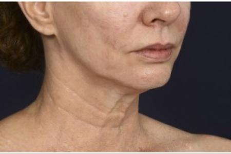 Before image 2 Case #86401 - 50 year old woman treated with lower facial rejuvenation