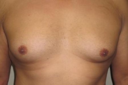 Before image 1 Case #82406 - 37 Male Gynecomastia