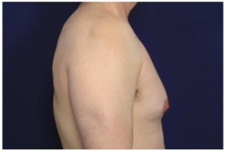 Before image 3 Case #86206 - 42 year old man treated with Male Breast Reduction
