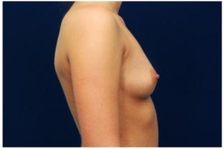 Before image 3 Case #81986 - Breast Augmentation