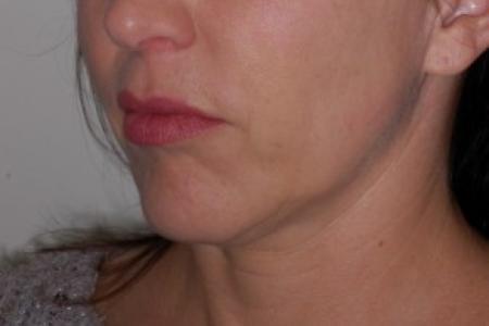 Before image 1 Case #87216 - Chin Implant