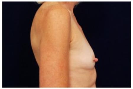 Before image 3 Case #81981 - Breast Augmentation