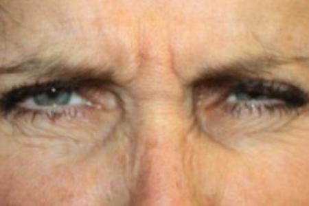 Before image 1 Case #85301 - Botox (Glabella & Crows Feet) - 54 year old female.