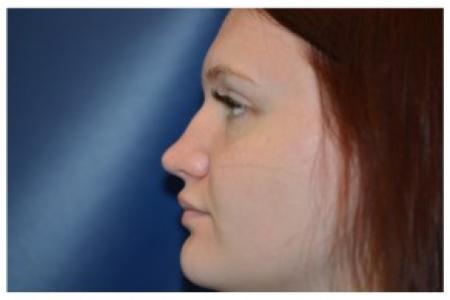 Before image 2 Case #87101 - Non-Surgical Rhinoplasty