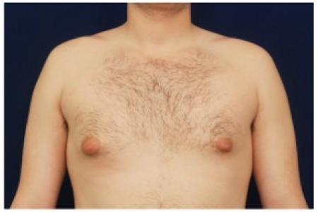 Before image 1 Case #82161 - Gynecomastia